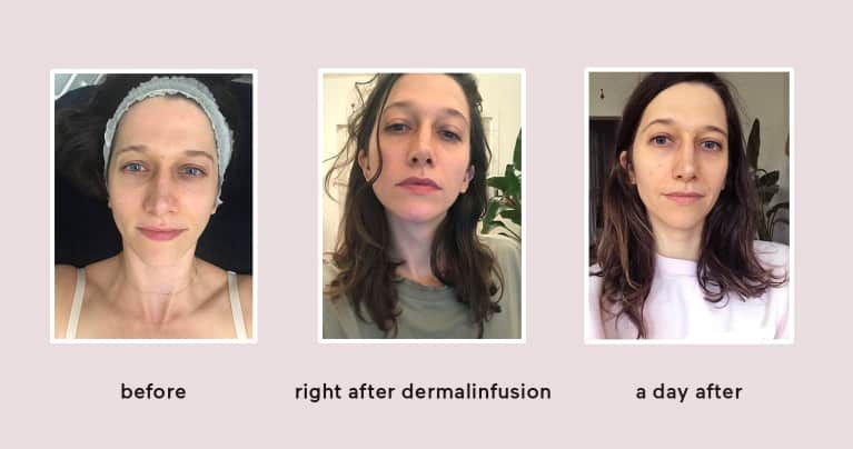 Revisión facial de dermalinfusión: aquí