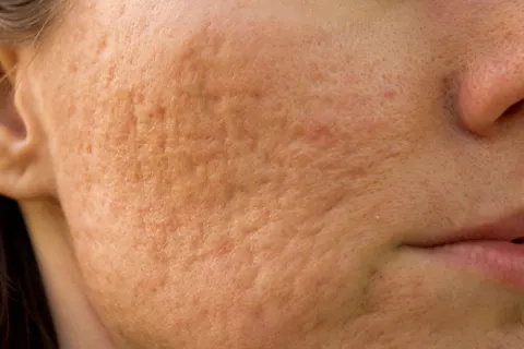 kvinde med acne ar