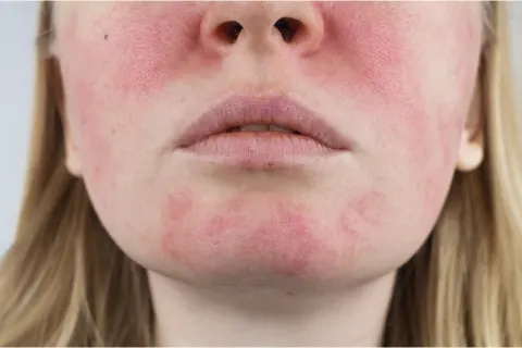 kvinde med rosacea