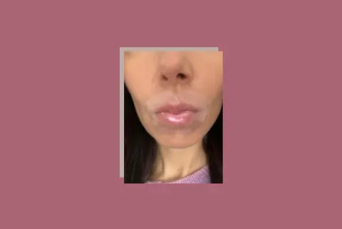   τζελ ανανέωσης χειλιών patchology