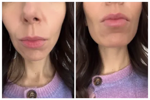   τζελ ανανέωσης χειλιών patchology