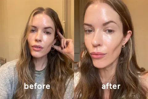   Η διευθύντρια ομορφιάς της mindbodygreen Alexandra Engler πριν και μετά τη χρήση του λέιζερ LYMA