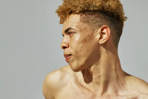   Sideprofil af mand med hudtekstur og acne ar på kinden