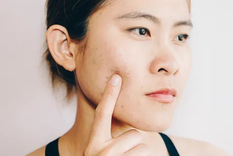  Kvinde med acne ar